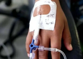 Una Menor Murió a Causa de Quemaduras del 95 % de su Cuerpo